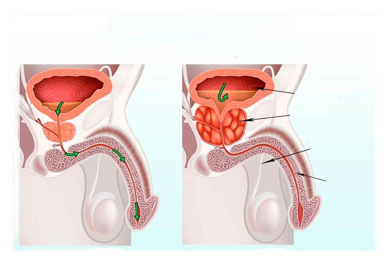 Norm an Entzündung vun der Prostatabdrüse