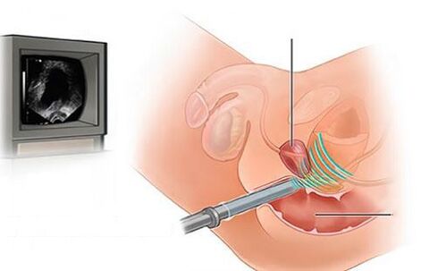 Ultraschall vun der Prostata