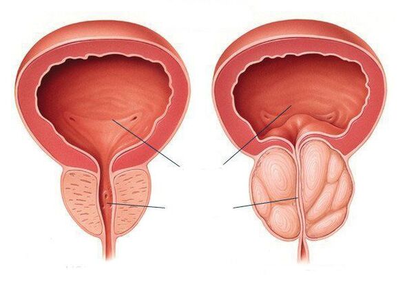 normal Prostata an Prostata Entzündung