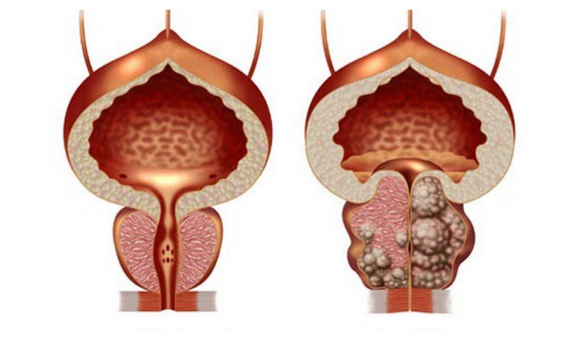 prostata adenoma